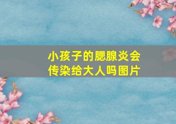 小孩子的腮腺炎会传染给大人吗图片