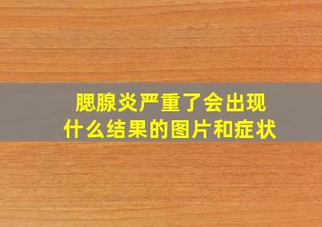 腮腺炎严重了会出现什么结果的图片和症状